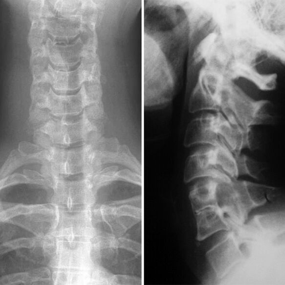 X -Rray la colonne cervicale