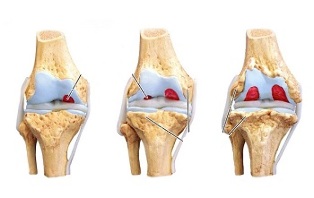 Stades de l'arthrose de l'articulation du genou