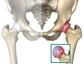 Causes de l'atrose de l'articulation de la hanche