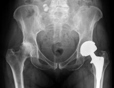 Diagnostic de l'arthrose de l'articulation de la hanche