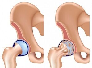 Les symptômes de l'arthrose de l'articulation de la hanche