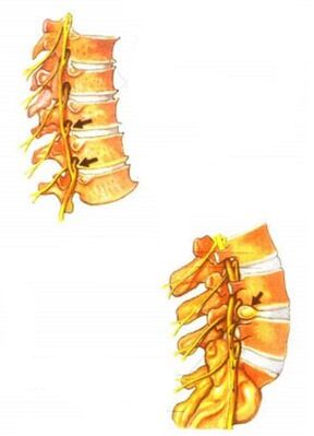 Illustration de l'ostéochondrose de la colonne vertébrale