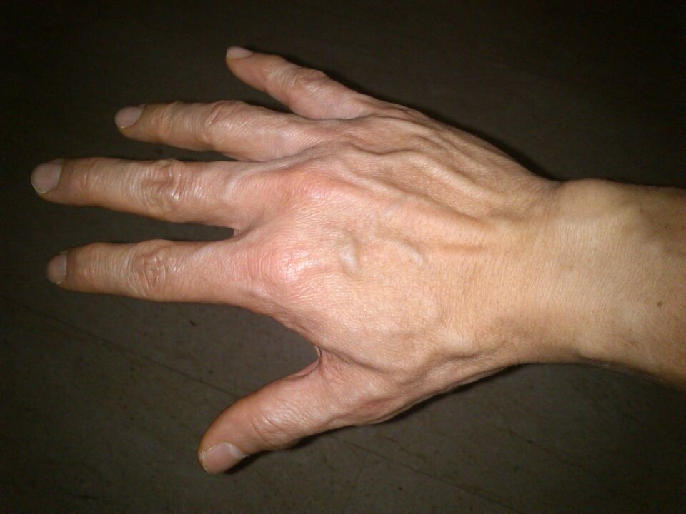 Déformation osseuse et douleur dans les articulations des doigts
