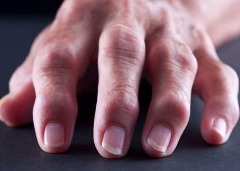 polyarthrite rhumatoïde comme cause de douleur dans les articulations des doigts